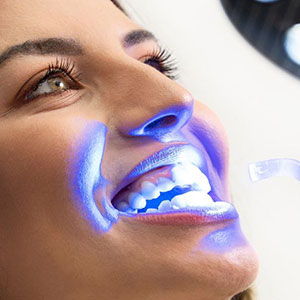 home-clareamento-dental