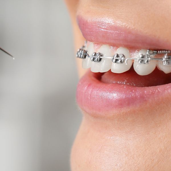 Nova Geração de Alinhadores em Ortodontia – Mais Rápido e