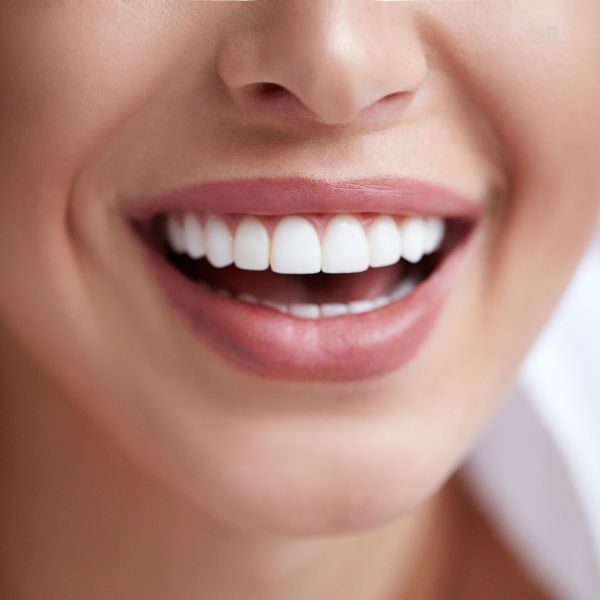 Clareamento Dental: O que Você Precisa Saber para um Sorriso Radiante.