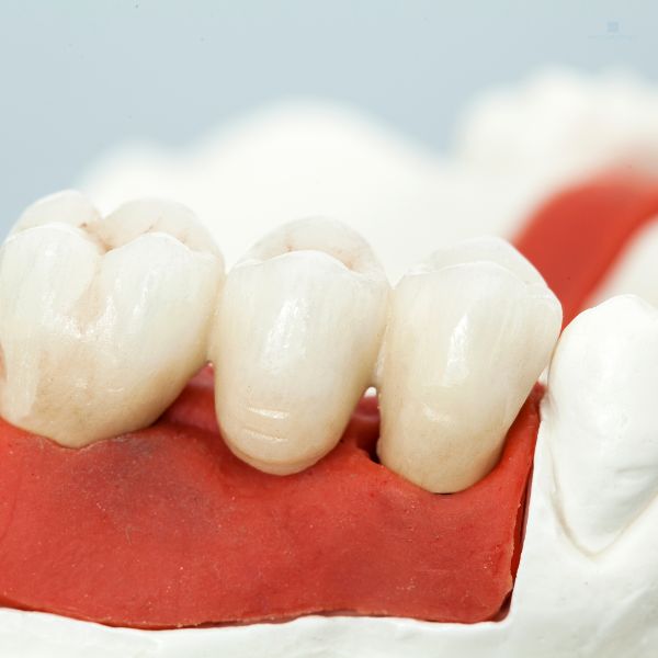 Coroas Dentárias: Restauração e Beleza Para o Seu Sorriso.