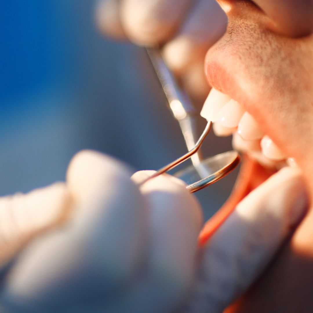 A profilaxia dental, também conhecida como limpeza de consultório, é um procedimento essencial realizado por profissionais de odontologia com o intuito de manter e promover a saúde bucal.