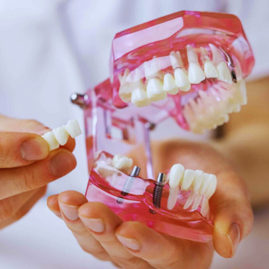 A importância dos implantes vai além da saúde bucal. Ao devolver a confiança ao sorriso, eles impactam diretamente a autoestima das pessoas, permitindo que se sintam mais seguras em interações sociais.