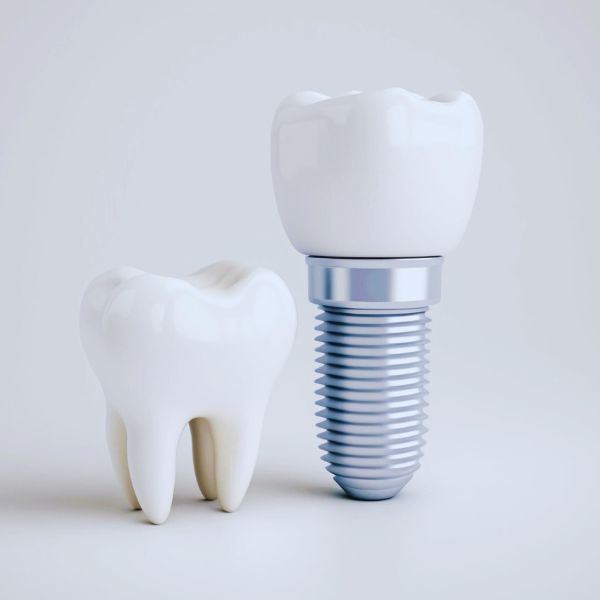 As Vantagens dos Implantes Dentários que Transformam sua Autoestima.