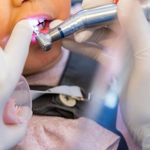 Os Benefícios dos Selantes dentários na Prevenção de Cáries em Crianças.