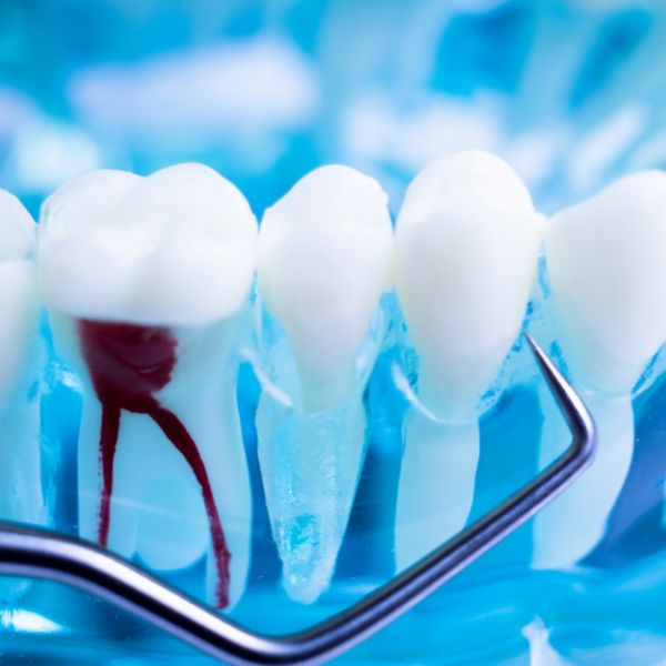 Como o Tratamento de Canal Pode Salvar seu Dente.