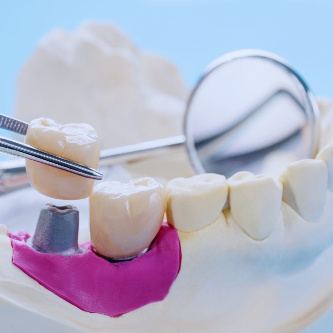 Além de melhorar a aparência do sorriso, a coroa desempenha um papel essencial na restauração da função do dente.