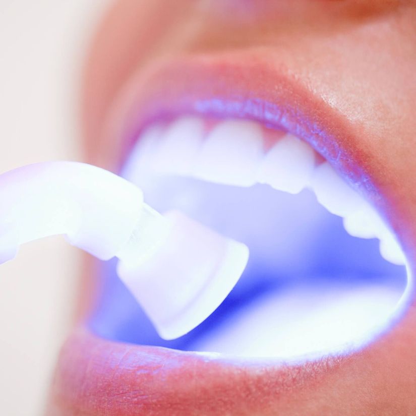 A Importância da Avaliação Profissional antes do Clareamento Dental.