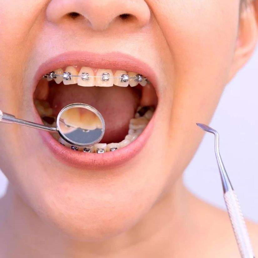 Aparelho Fixo Convencional e seus Benefícios para a Saúde Bucal.
