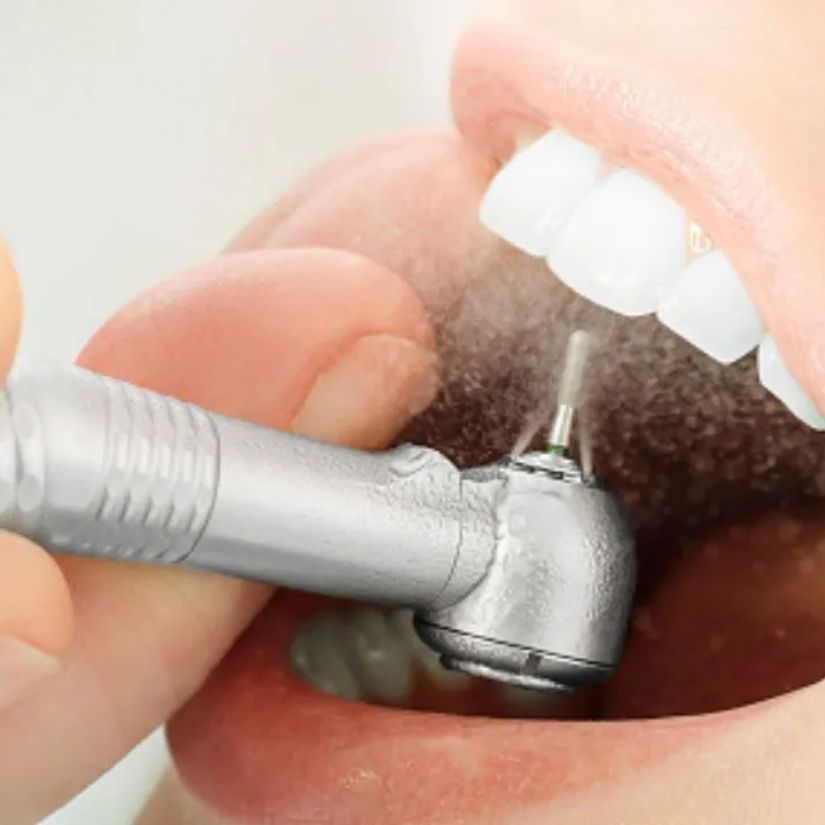 Como é Realizada a Limpeza Dental no Consultório Odontológico.