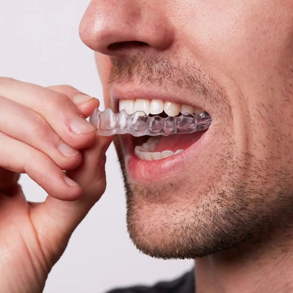 Placas Oclusais e Bruxismo: Como Proteger seus Dentes de Forma Eficaz.