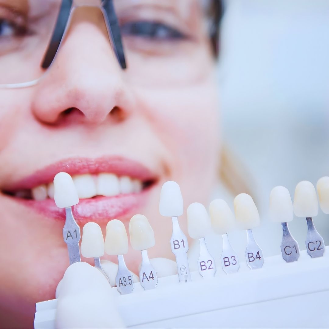 As lentes de contato dental são uma solução inovadora para quem deseja transformar o sorriso de forma discreta e eficaz.