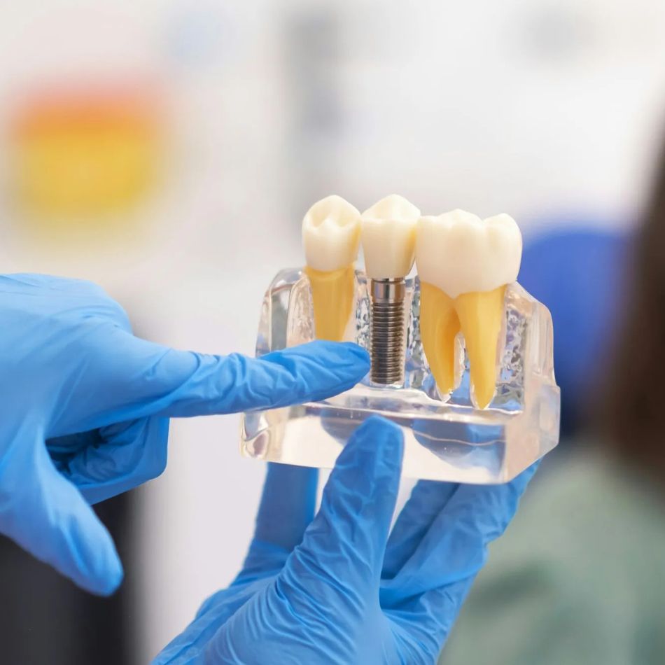 Entendendo a Osseointegração e sua Importância nos Implantes Dentários.